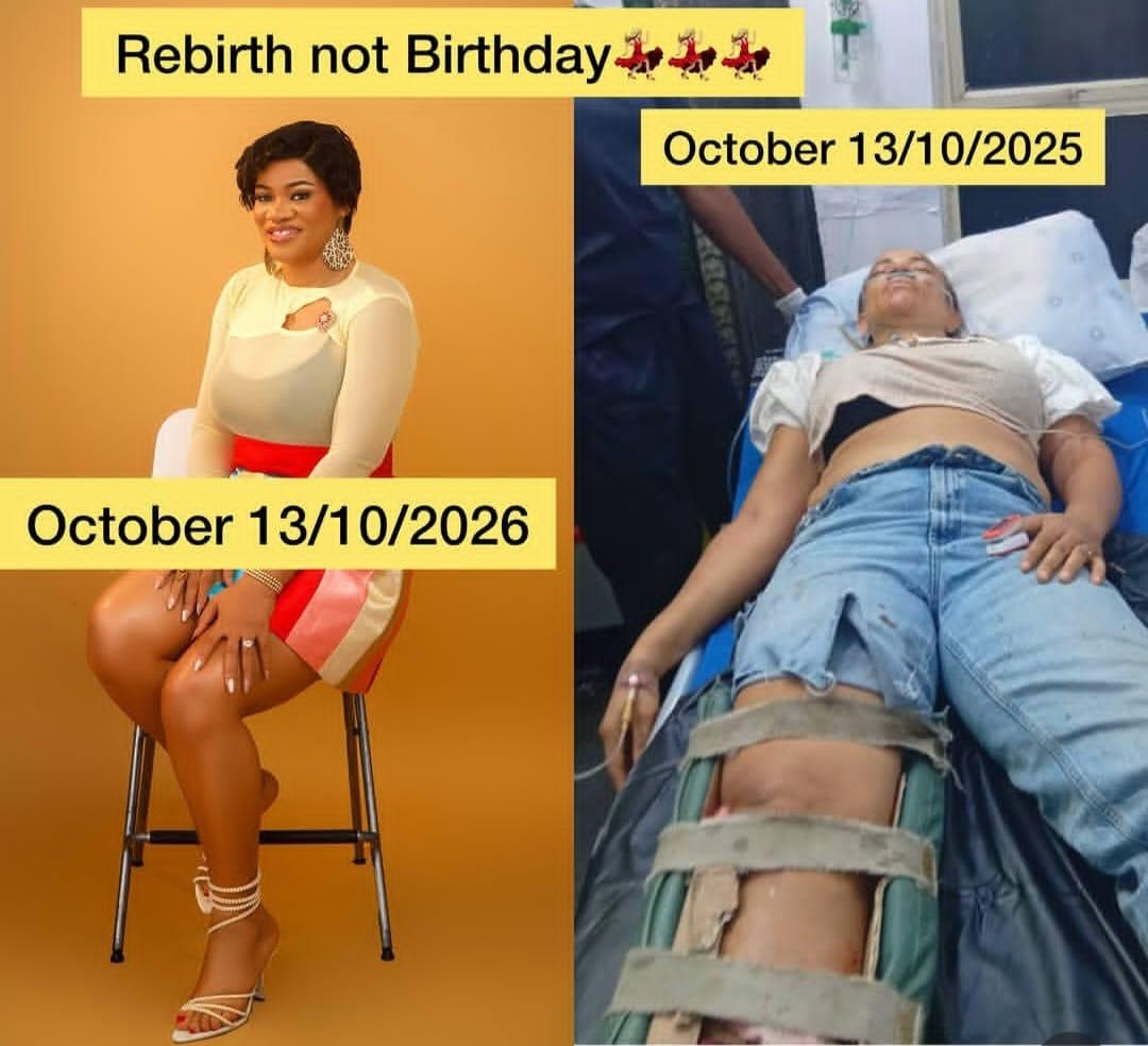 Uche Nnanna Displays Accident Scars, Marks One-Year Survival