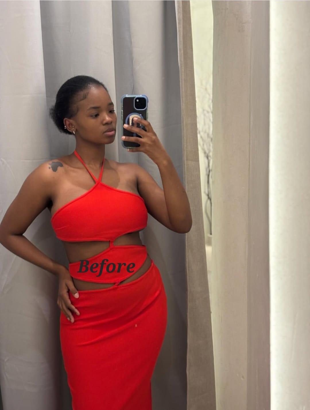Breasts Re-Grow After Reduction: Woman Considers Second Surgery