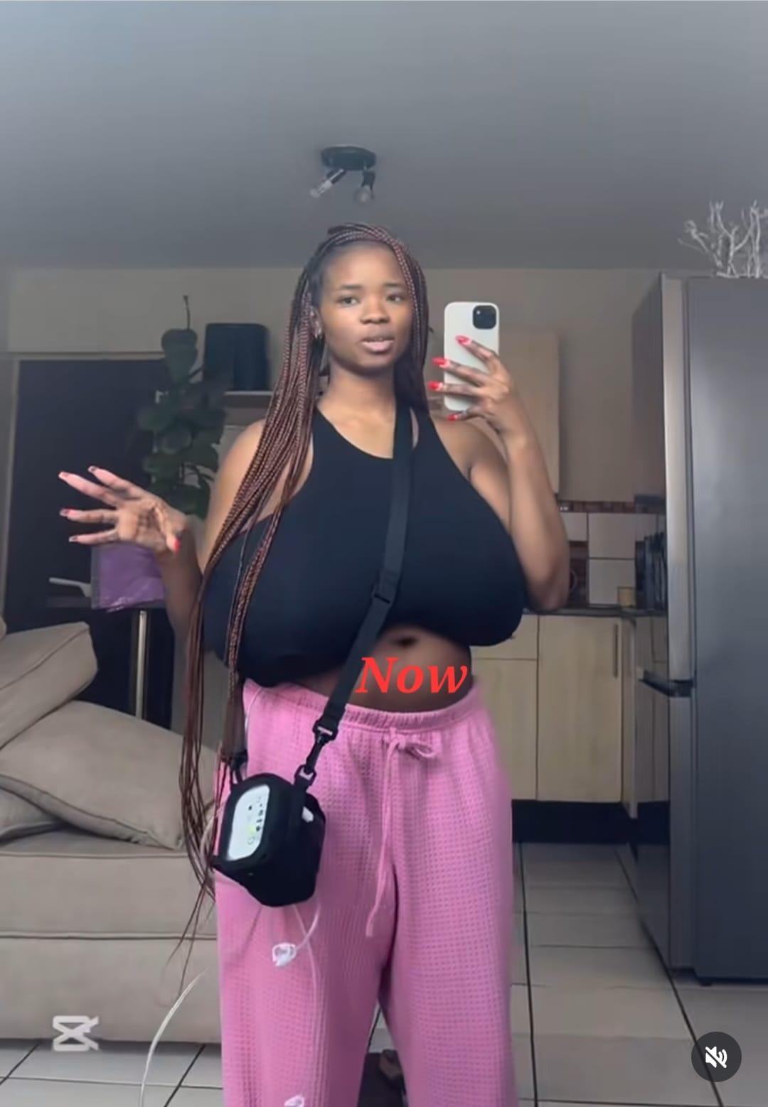 Woman whose breasts re-grew after initial surgery.