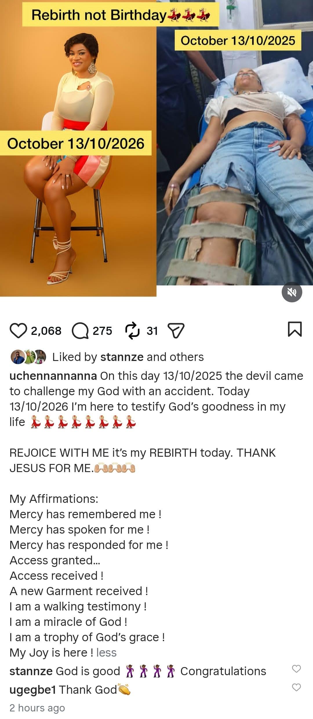 Uche Nnanna displaying the physical reminders of her accident.
