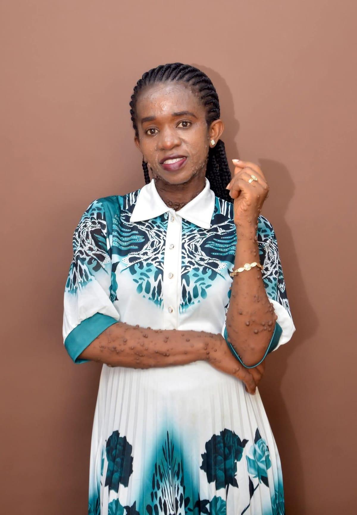 Neurofibromatosis Patient Eseoghene Oghenekevwe Faces Church Snubs During Peace Sign Ritual