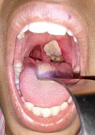 Plateau State Battles Diphtheria: 23 Fatalities, 143 Suspected Cases Emerge