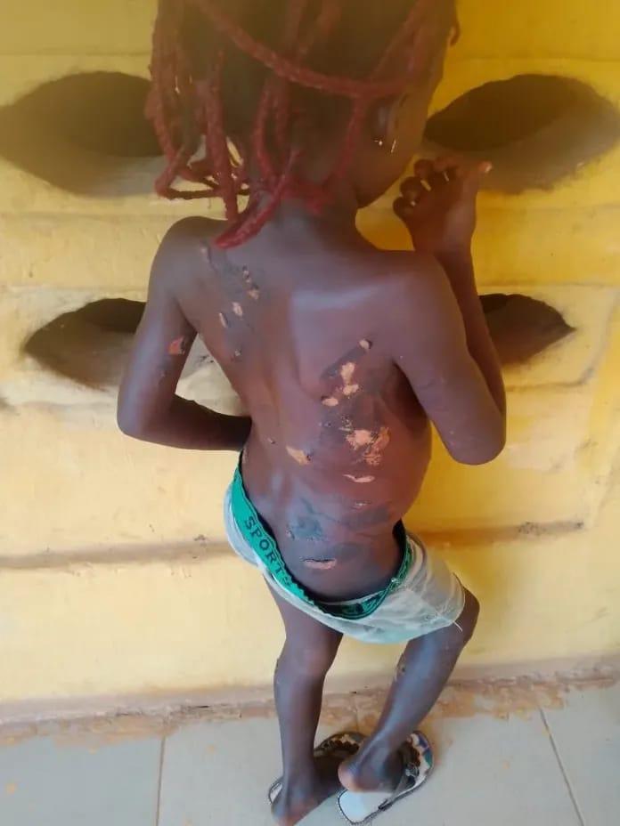 Anambra Woman Nabbed After Allegedly Burning 7-Year-Old Daughter with Hot Knife