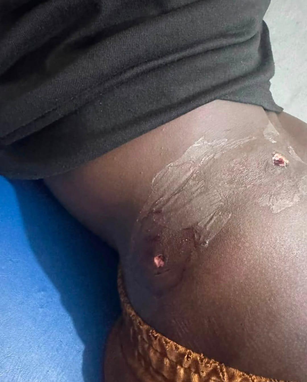 A closer view of MC Oracle's injury, revealing the extent of the gunshot wound.